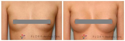 /upload/old_kmh/special_photo/public/High-Precision%20Endoscopic%20Breast%20Augmentation.jpg